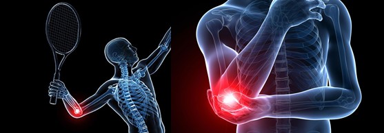 NE Philadelphia, PA - Tennis Elbow Treatment, Therapy and Pain Relief by Chiropractor, Dr in NE Philadelphia, PA |19114|19115|19116|19136